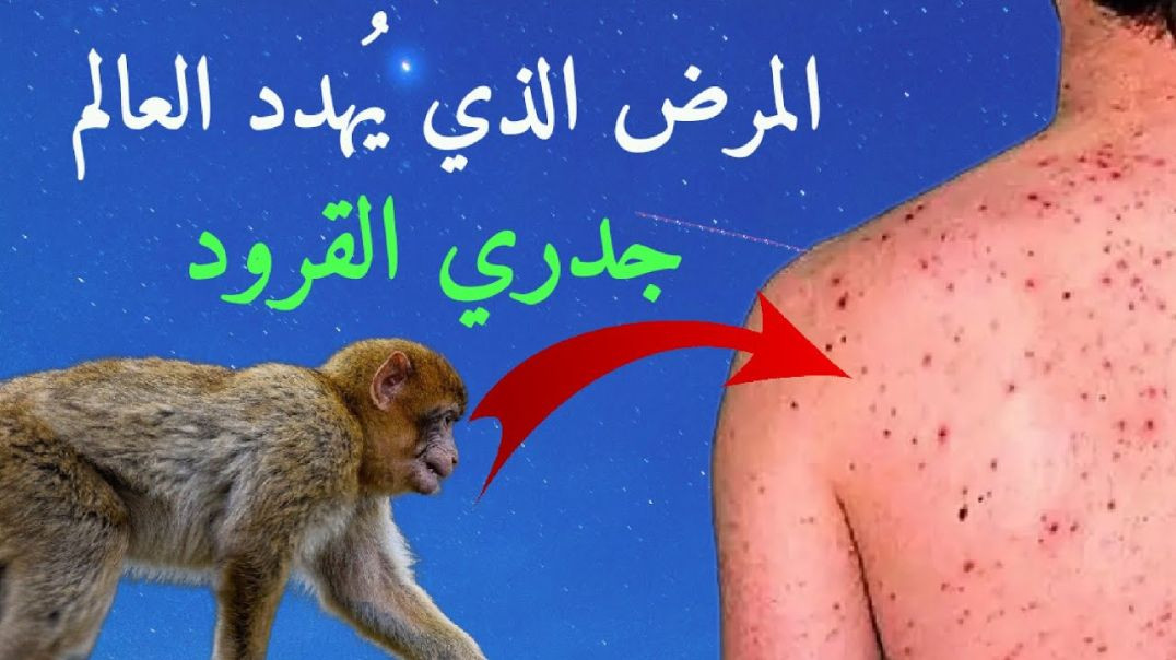 ⁣كل ما تود معرفته عن جدرى القرود وكيفية الوقايه منه؟ Monkeypox